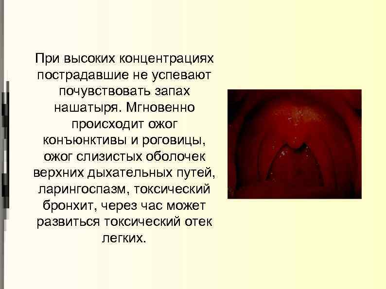 При высоких концентрациях пострадавшие не успевают почувствовать запах нашатыря. Мгновенно происходит ожог конъюнктивы и