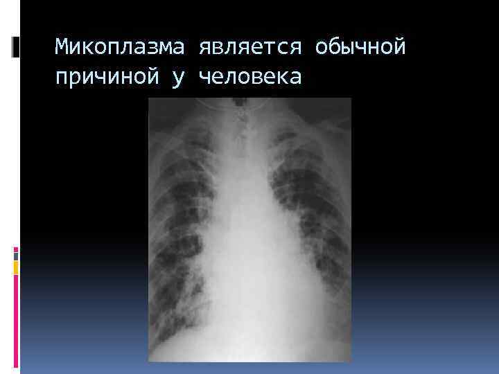 Микоплазма является обычной причиной у человека 