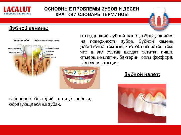 ОСНОВНЫЕ ПРОБЛЕМЫ ЗУБОВ И ДЕСЕН КРАТКИЙ СЛОВАРЬ ТЕРМИНОВ Зубной камень: отвердевший зубной налёт, образующийся