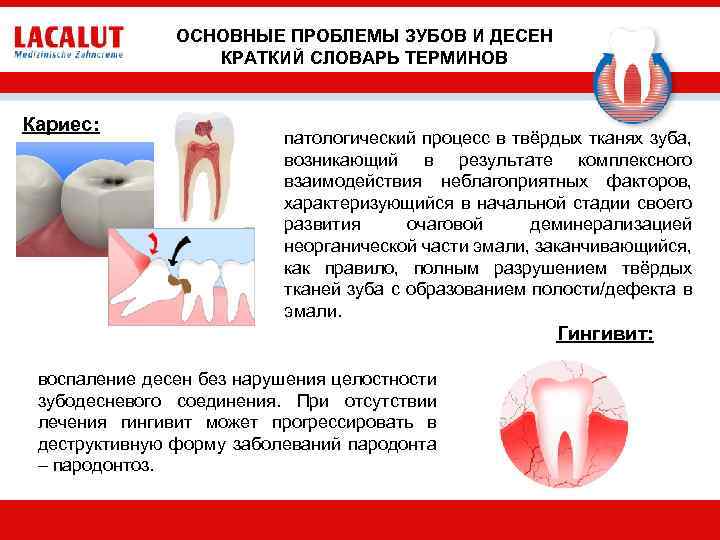 ОСНОВНЫЕ ПРОБЛЕМЫ ЗУБОВ И ДЕСЕН КРАТКИЙ СЛОВАРЬ ТЕРМИНОВ Кариес: патологический процесс в твёрдых тканях