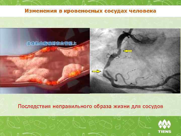 Изменения в кровеносных сосудах человека Последствия неправильного образа жизни для сосудов 