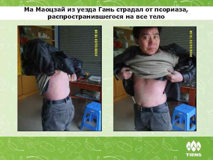 Ма Маоцзай из уезда Гань страдал от псориаза, распространившегося на все тело 