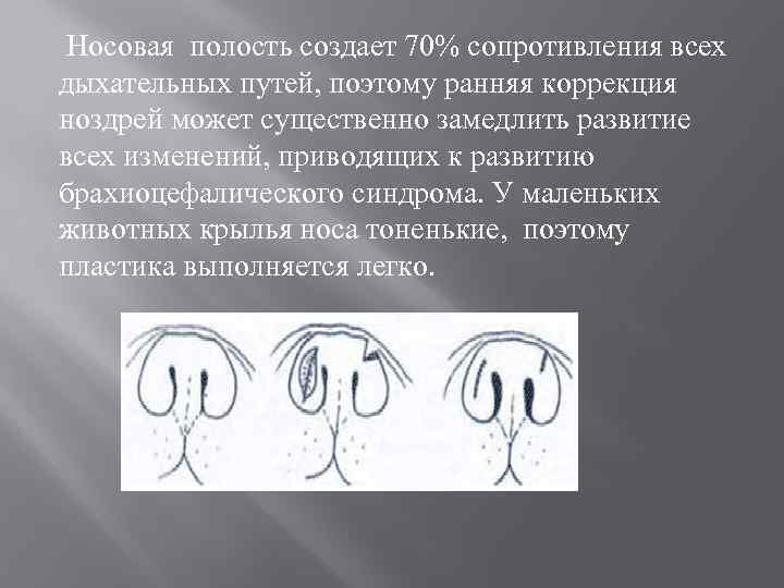 Носовая полость создает 70% сопротивления всех дыхательных путей, поэтому ранняя коррекция ноздрей может существенно