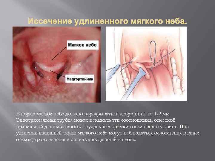 Иссечение удлиненного мягкого неба. В норме мягкое небо должно перекрывать надгортанник на 1 -2