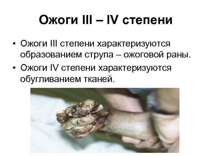  Ожоги III – IV степени • Ожоги III степени характеризуются образованием струпа –