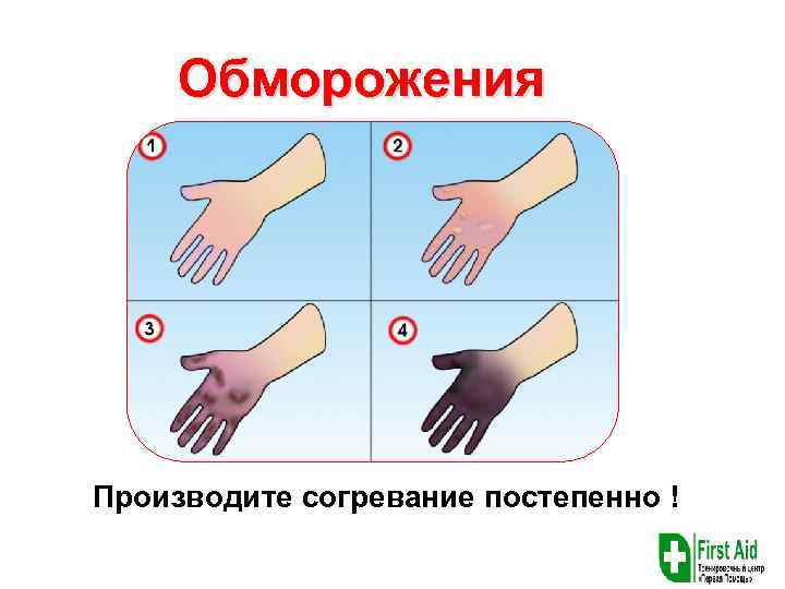 Обморожения Производите согревание постепенно ! 