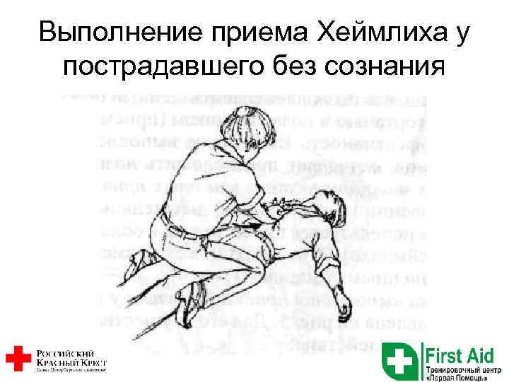Выполнение приема Хеймлиха у пострадавшего без сознания 