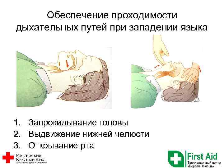 Обеспечение проходимости дыхательных путей при западении языка 1. Запрокидывание головы 2. Выдвижение нижней челюсти