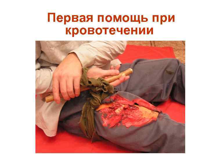  Первая помощь при кровотечении 