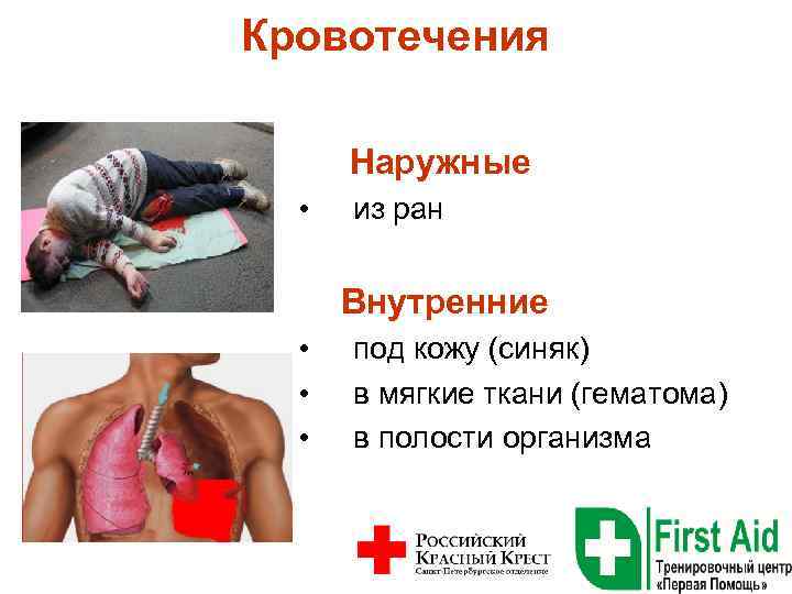 Кровотечения Наружные • из ран Внутренние • под кожу (синяк) • в мягкие ткани