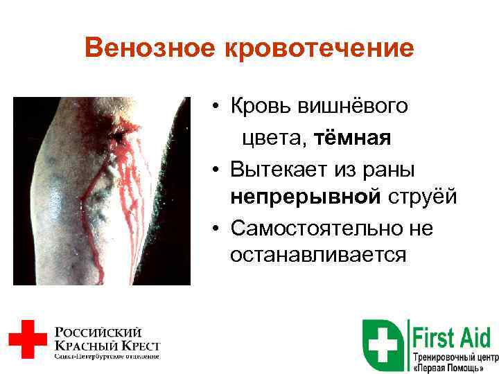 Венозное кровотечение • Кровь вишнёвого цвета, тёмная • Вытекает из раны непрерывной струёй •