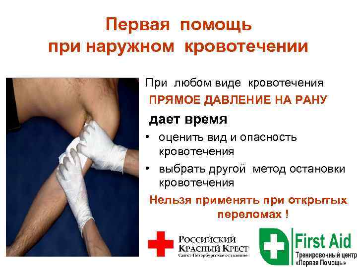 Первая помощь при наружном кровотечении При любом виде кровотечения ПРЯМОЕ ДАВЛЕНИЕ НА РАНУ дает