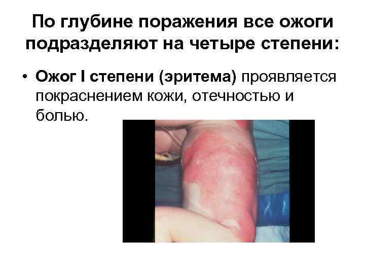 По глубине поражения все ожоги подразделяют на четыре степени: • Ожог I степени (эритема)