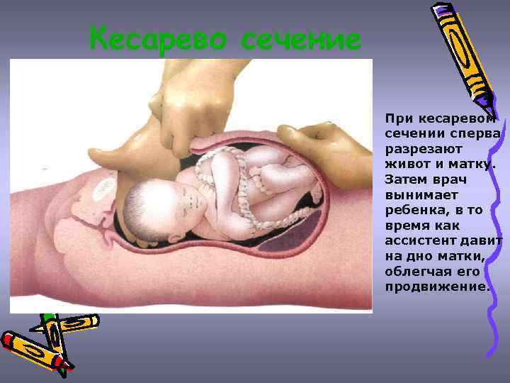 Кесарево сечение При кесаревом сечении сперва разрезают живот и матку. Затем врач вынимает ребенка,