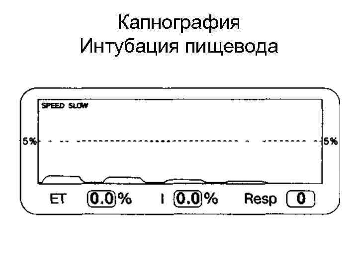 Капнография Интубация пищевода 