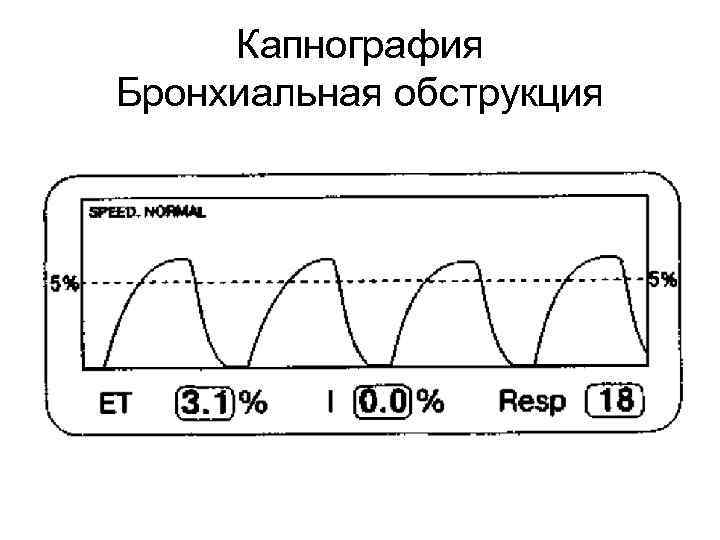 Капнография Бронхиальная обструкция 