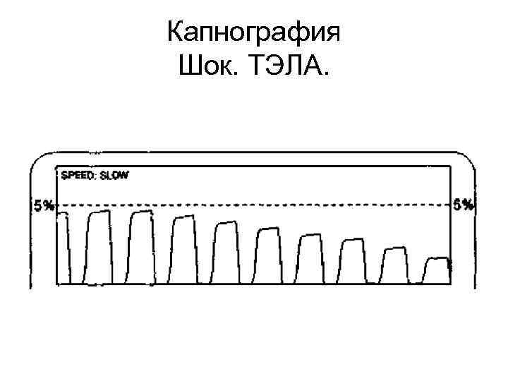 Капнография Шок. ТЭЛА. 