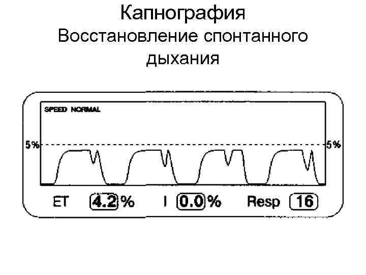 Капнография Восстановление спонтанного дыхания 