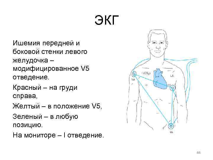 Экг передняя стенка отведения