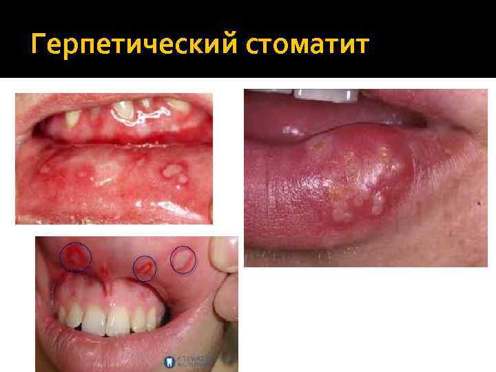 Герпетический стоматит 