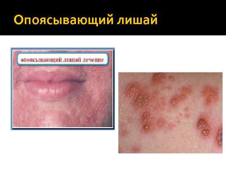 Опоясывающий лишай 