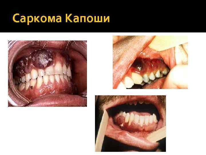 Саркома Капоши 