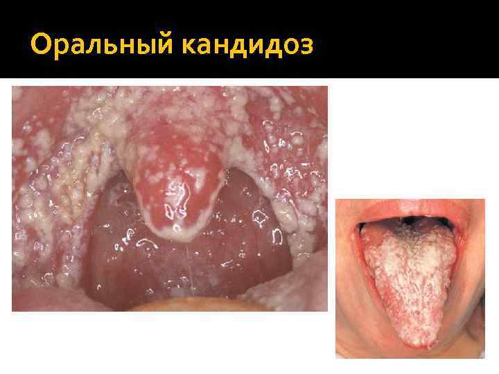 Оральный кандидоз 