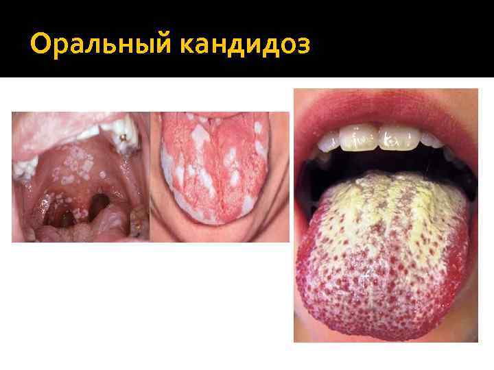 Оральный кандидоз 
