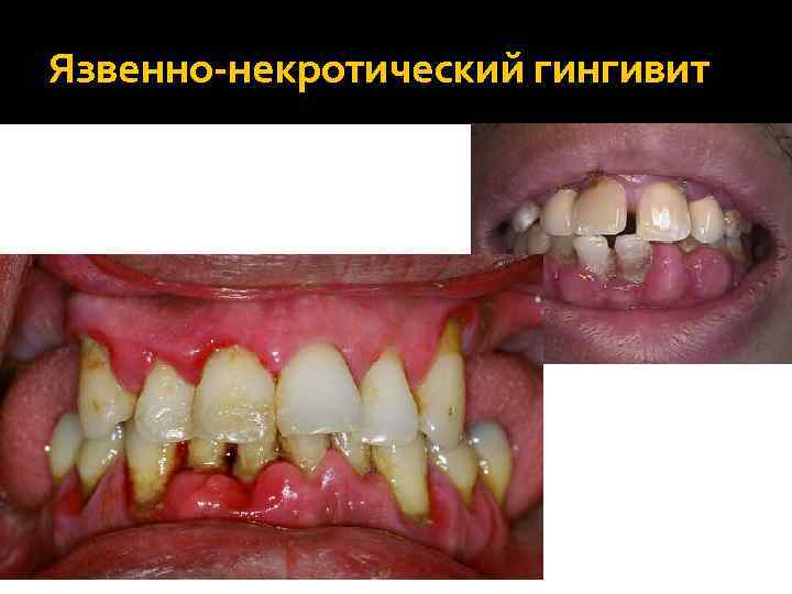 Язвенно-некротический гингивит 