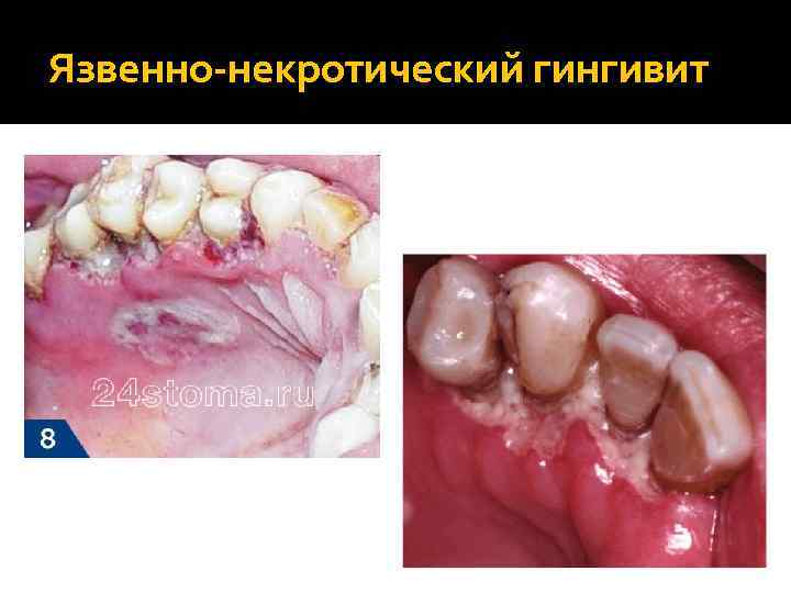 Язвенно-некротический гингивит 