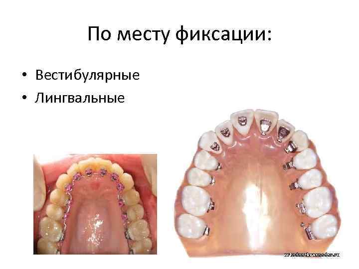 По месту фиксации: • Вестибулярные • Лингвальные 