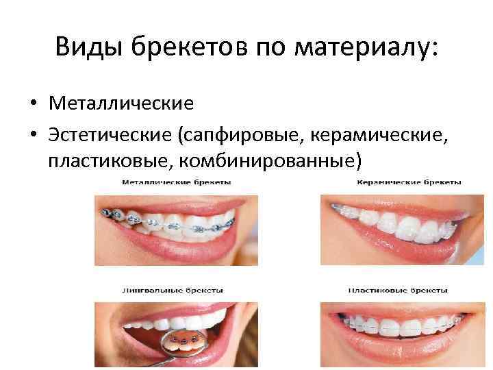 Виды брекетов по материалу: • Металлические • Эстетические (сапфировые, керамические, пластиковые, комбинированные) 