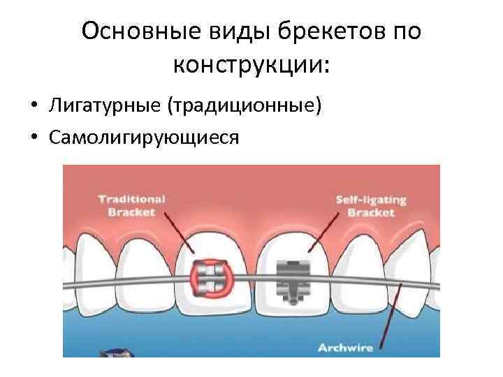 Презентация по брекет системам