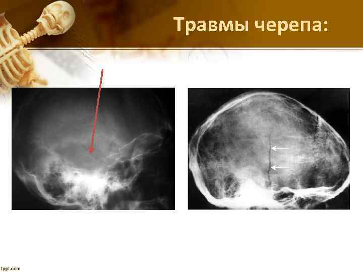 Травмы черепа: 