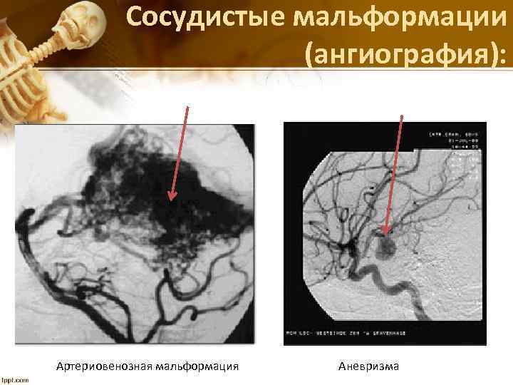 Сосудистые мальформации (ангиография): Артериовенозная мальформация Аневризма 