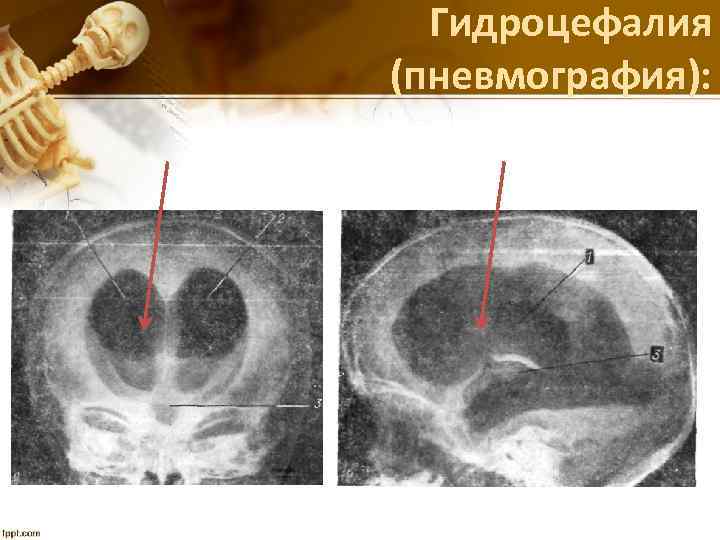 Гидроцефалия (пневмография): 