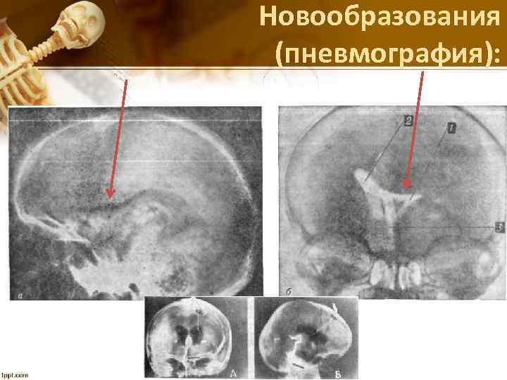 Новообразования (пневмография): 