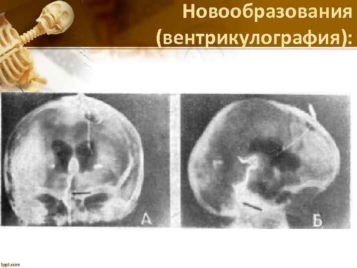 Новообразования (вентрикулография): 
