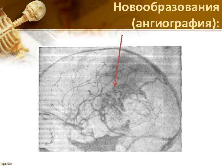 Новообразования (ангиография): 