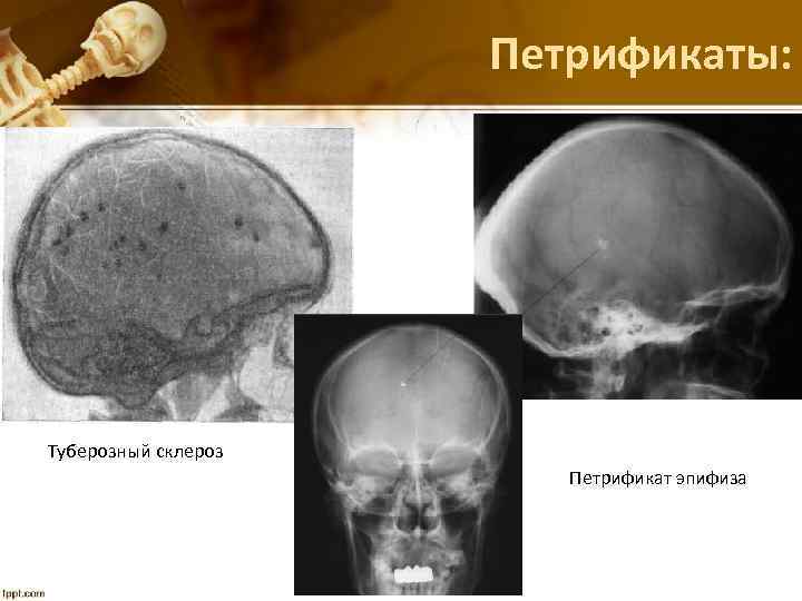 Петрификаты: Туберозный склероз Петрификат эпифиза 