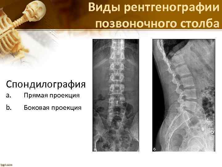 Виды рентгенографии позвоночного столба Спондилография a. Прямая проекция b. Боковая проекция 