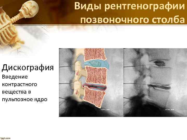 Виды рентгенографии позвоночного столба Дискография Введение контрастного вещества в пульпозное ядро 
