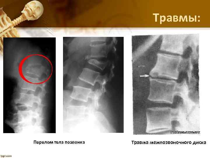 Травмы: Перелом тела позвонка Травма межпозвоночного диска 