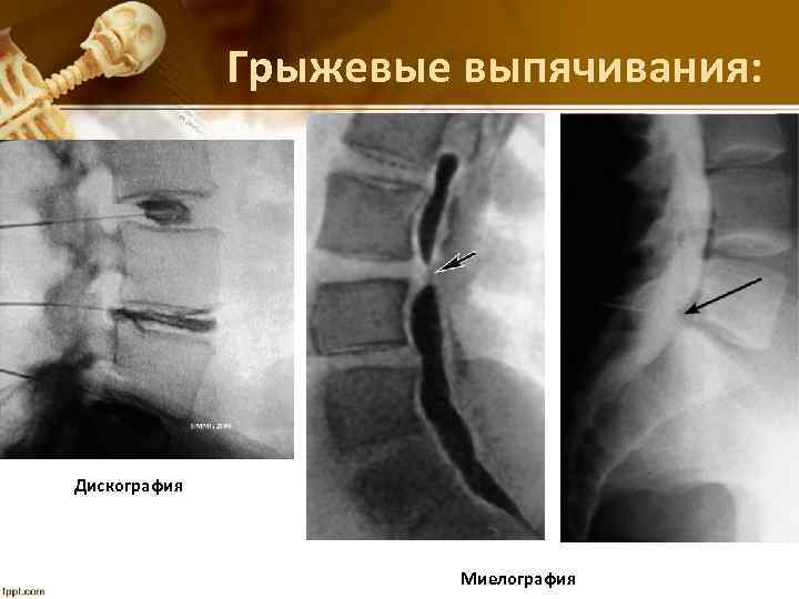 Грыжевые выпячивания: Дискография Миелография 
