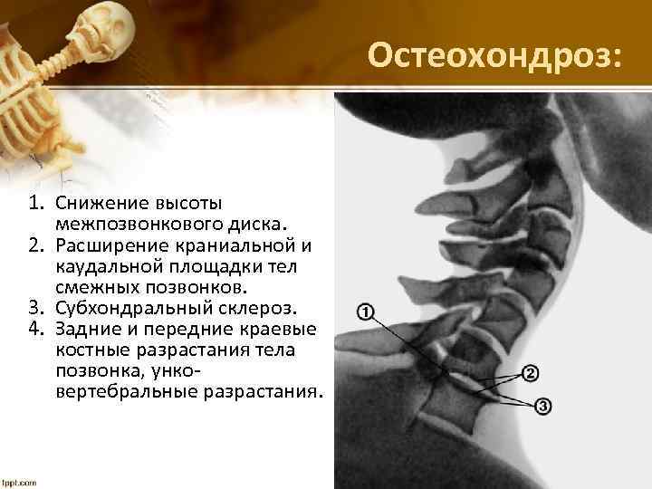 Остеохондроз: 1. Снижение высоты межпозвонкового диска. 2. Расширение краниальной и каудальной площадки тел смежных