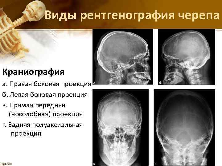 Виды рентгенография черепа Краниография а. Правая боковая проекция б. Левая боковая проекция в. Прямая