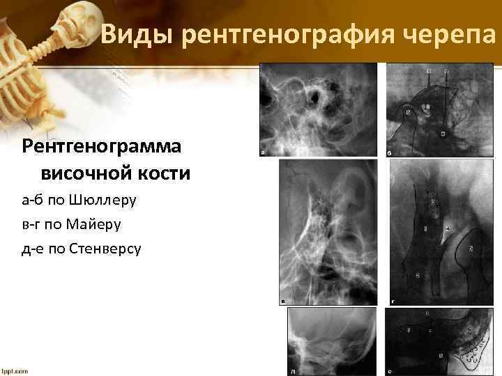 Виды рентгенография черепа Рентгенограмма височной кости а-б по Шюллеру в-г по Майеру д-е по