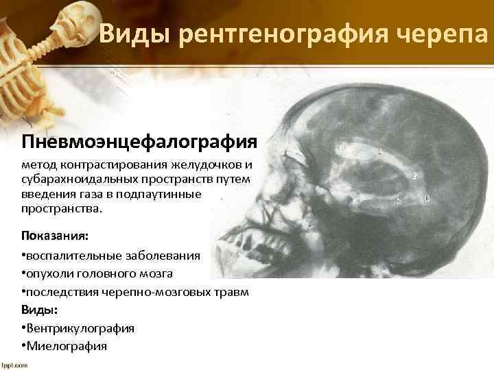 Виды рентгенография черепа Пневмоэнцефалография метод контрастирования желудочков и субарахноидальных пространств путем введения газа в