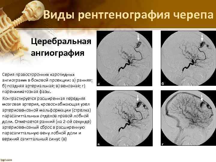 Виды рентгенография черепа Церебральная ангиография Серия правосторонних каротидных ангиограмм в боковой проекции: а) ранняя;