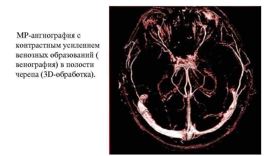 Мрт с контрастным усилением. Венография мрт. Венография головного мозга.